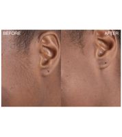 9er Sparpack bondiblades Damen Derma Razor Dermaplaning-Rasierer zur entfernung von Flaumhaaren Gesichtsrasierer Rosa